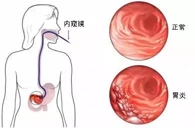 一枚小膠囊，看清你的胃！